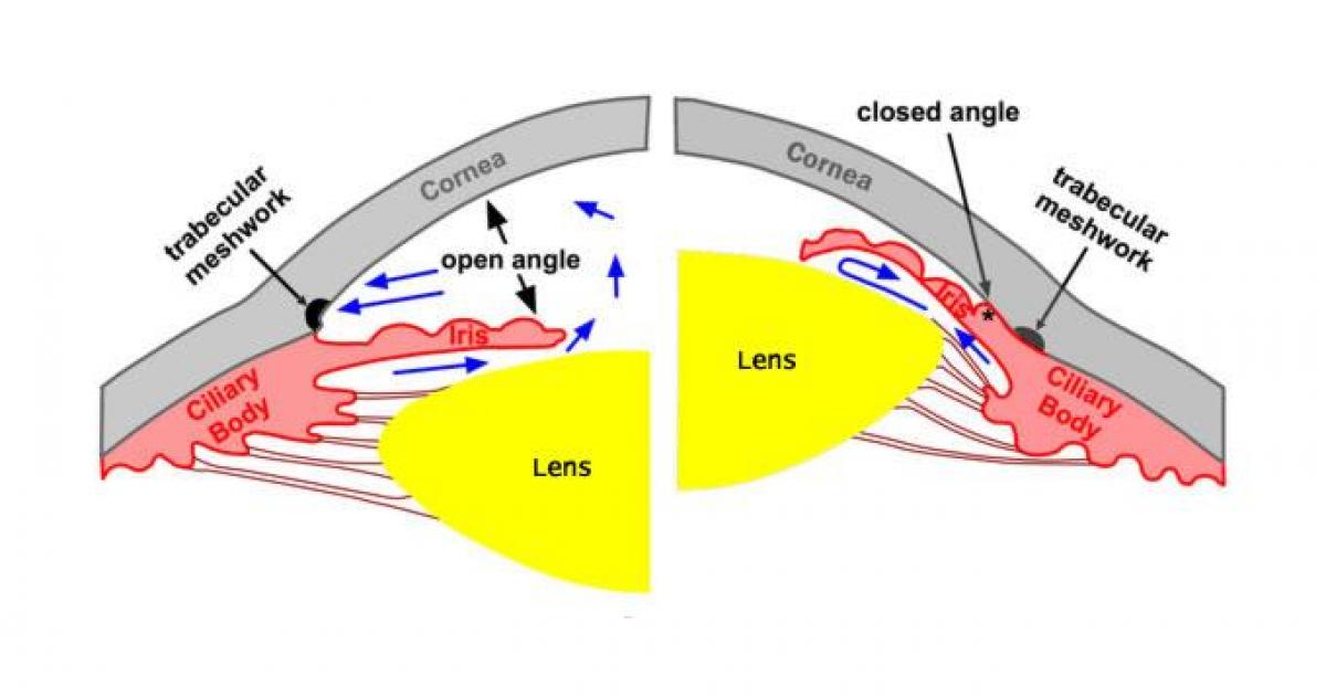 narrow_angle_glaucoma